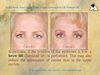 Dr Kris Reddy Reviews Brow Lift (forehead lift)