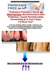 Psoriasis Home Remedies - New Treatment For Psoriasis