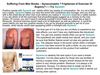 Gynexin Male Breast Reduction- Treatment for Gynecomastia