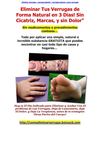  eliminar verrugas - verruga plantar - verrugas planas -curar verrugas