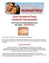 tinea versicolor treatment