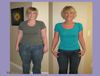 Complications of Gastric Band Surgery