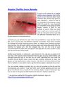 Angular Cheilitis Home Remedy
