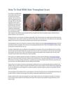 How To Deal With Hair Transplant Scars