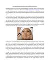 Microdermabrasion Acne Scars- How to get Rid of Acne Scars