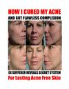 How I Cured My Acne