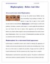 Blepharoplasty - Before And After