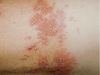 Tratamiento Para El Herpes Zoster