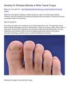 Deciding On Effortless Methods In White Toenail Fungus